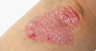 penyakit kulit Psoriasis
