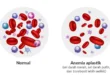 Anemia Aplastik